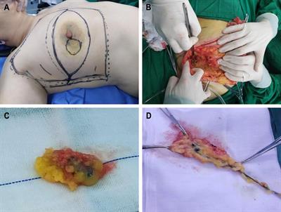 Comparative observation of common tracers in sentinel lymph node biopsy of breast cancer and a study on simplifying its surgical procedure